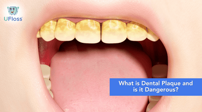 What is Dental Plaque and is it Dangerous?