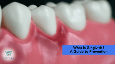 What is Gingivitis? A Guide to Prevention